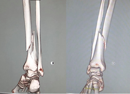 骨折したサンクスラボ代表村上のレントゲン